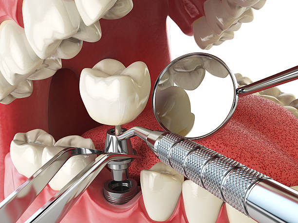 Best Emergency Dentist for Lost Fillings or Crowns in Dayton, KY